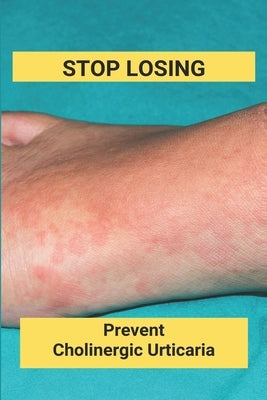 Stop Losing: Prevent Cholinergic Urticaria: Losing Itchy Hair by Camarda, Kenyetta